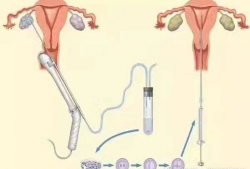 人工授精视频,科技助力生育新篇章